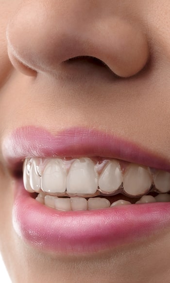 A woman with Invisalign in her mouth smiling
