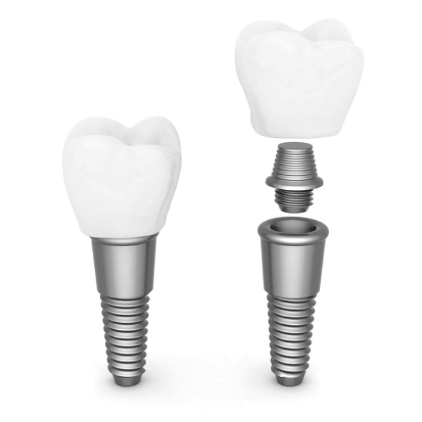 An illustration of the three parts of a dental implant